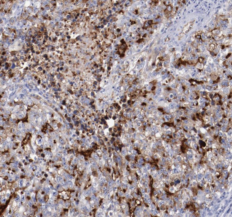 PODXL expression in testicular cancer Human embryonal