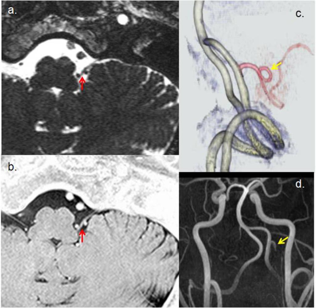 Fig. 1: MRI study of patient 1. (a) 3D-CISS and (b) 3D-T2R Axial view. The left glossopharyngeal nerve appears to be in contact with the PICA at the REZ, and is shifted by the PICA (red arrow).
