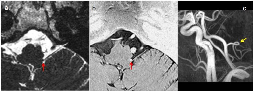 Fig. 2: MRI study of patient 5. (a) 3D-CISS and (b) 3D-T2R Axial view. The left glossopharyngeal nerve appears to be in contact with the PICA at the REZ, and is shifted by the PICA (red arrow).