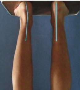 nailing. Figure 4: Clinical images showing differences in opposite extremities due to weight-bearing.