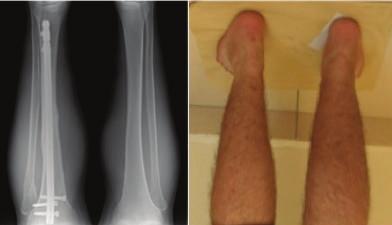 Results All patients demonstrated radiographic union of both the tibia and fibula.