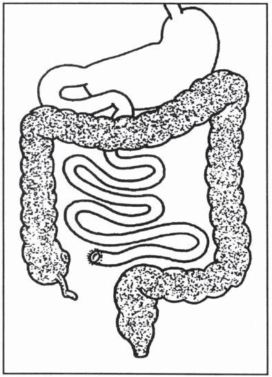 SURGICAL ALTERNATIVES Ulcerative colitis and familial polyposis coli affect only the lining of the large bowel and, therefore, are cured by the following surgical procedures. I.