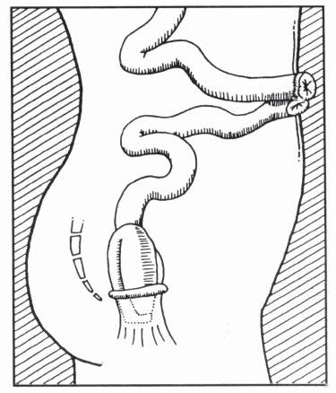 In the more than two hundred ileoanal Total Colectomy With Ileoanal pouches created by the colorectal surgeons Anastomosis Figure #6 of the Calgary District Hospital Group, a