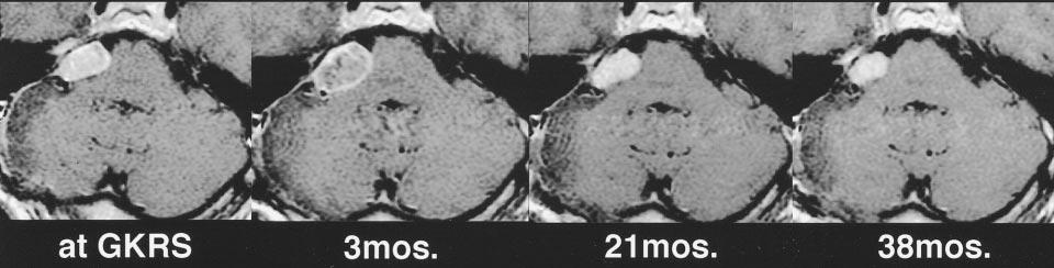 AJNR: 21, September 2000 VESTIBULAR SCHWANNOMA 1543 FIG 3. Serial contrast-enhanced axial T1-weighted images (450/17/5) in a 51-year-old man.