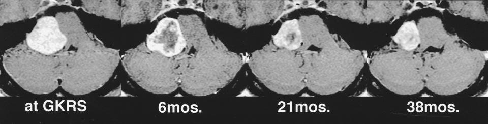 , months after gamma knife radiosurgery. FIG 4. Serial contrast-enhanced axial T1-weighted images (450/17/5) in a 25-year-old woman.