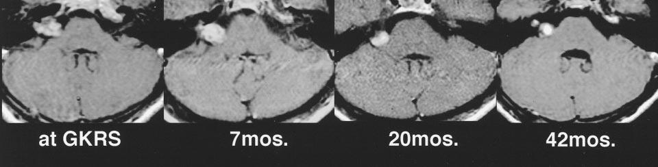 Note the continuous enlargement of the tumor, although with transient loss of contrast enhancement. GKRS indicates gamma knife radiosurgery; mos., months after gamma knife radiosurgery. FIG 7.