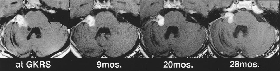 continuous increase in contrast enhancement without transient loss of contrast enhancement. GKRS indicates gamma knife radiosurgery; mos., months after gamma knife radiosurgery. FIG 8.