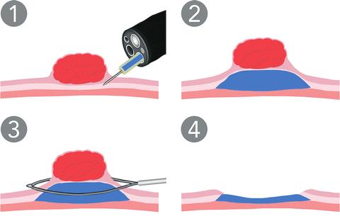 Safe Polyp Removal With Faster Recovery Time Endoscopic mucosal resection (EMR) and endoscopic submucosal dissection (ESD) are techniques used to remove large, flat polyps or lesions from the surface
