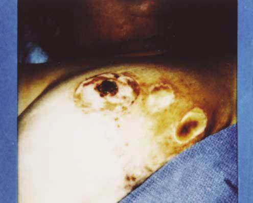 Figure 15. Skin necrosis of the breast medial flap. The surgeon performed a standard breast reduction and then attempted to debulk the medial flap without infiltration of tumescent solution.