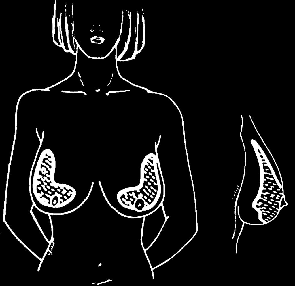 Figure 2. Distribution of glandular tissue in the breast cone.