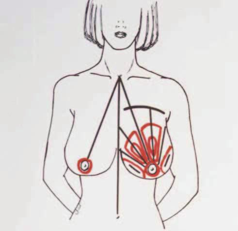 The tumescent solution was used to distend the breast area and induce severe vasoconstriction.