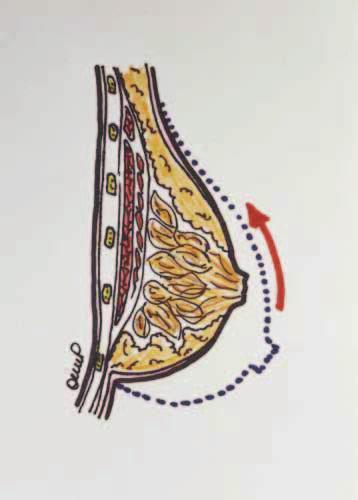 Figure 4. By thinning the lower pole, the breast cone naturally rotates upward. Figure 5.