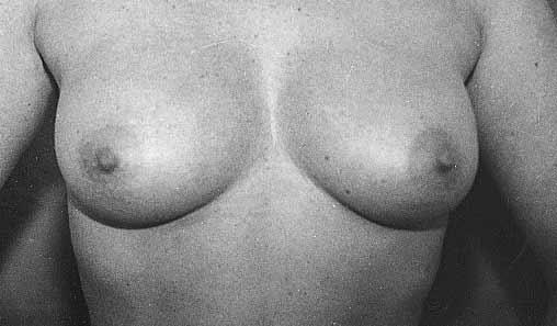 A C Figure 10. A, C, Preoperative photographs of a 29-year-old woman with moderate breast hypertrophy.