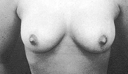 Breast sizers (CUI Corporation, Santa Ana, CA) were used to evaluate preoperative and postoperative breast measurements (Figure 8).