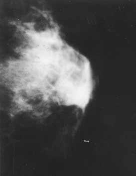 40-year-old woman before breast