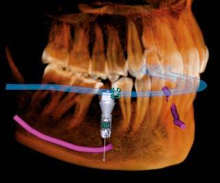A fusion module for stitching and superimposing images, and the In2Guide implant planning module for guided surgery needs, are available for those who want to extend the feature even further.