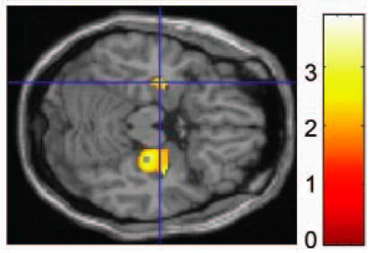 working, and visual memory» Worse bilateral hippocampal function correlated with worse episodic verbal memory Manly et al, JCEN 2011, 33(8): 853 Valcour et al, ARHR