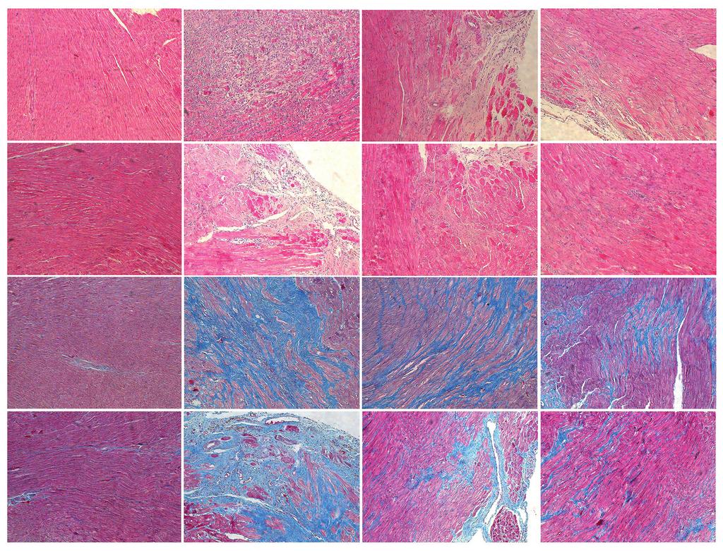 Lv S. et al.: A H&E staining ( weeks) H&E staining ( weeks) Masson staining ( weeks) Masson staining ( weeks) 5 * C 5 Collagen volume fraction (%) B Inflammation with a histological score Figure.