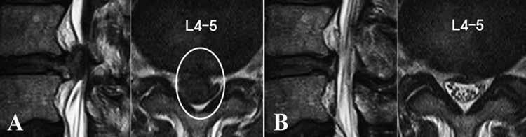 Evolution of PELD for Severely Diffucult and Extremely Difficult LDH Fig. 4. High canal compromised LDH. A) Preoperative MRI LDH encircled.