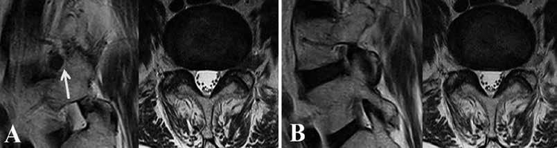 B) Postoperative MRI with complete removal of LDH. Fig. 6. Highly inferiorly migrated LDH with discal cyst. A) Preoperative MRI LDH encircled.