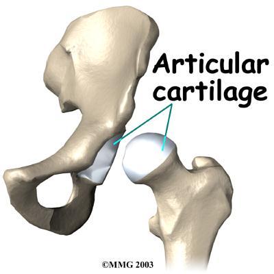 bone at the femoral head-neck junction (cam impingement) or at the edge of the acetabulum (pincer impingement).