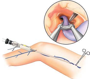1 With the Terumo VirtuoSaph Plus EVH System, the saphenous vein in the thigh and/or lower leg is harvested to be used as grafts for coronary artery bypass surgery (CABG).