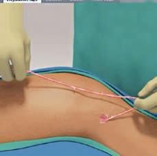 Open V-lock mechanism and capture the main saphenous vein by