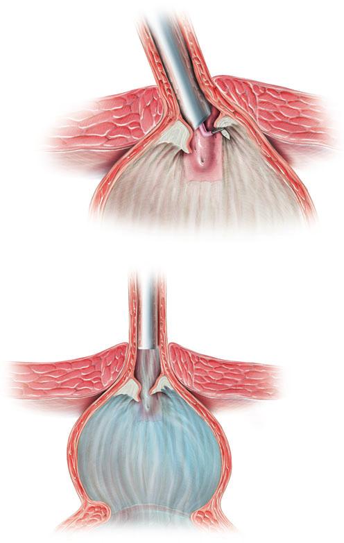SURGERY ILLUSTRATED Figure 9 After thoroughly resecting the denom, the remining picl tissue ecomes quite moile, similr to folding doors.
