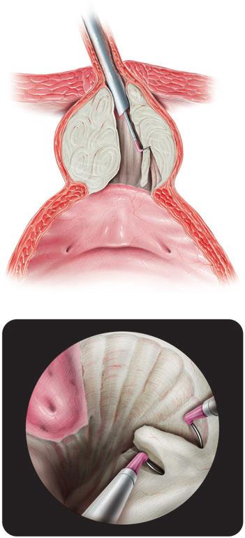 SURGERY ILLUSTRATED Figure 5 Resection in smller denoms is now crried directly to the side loe.