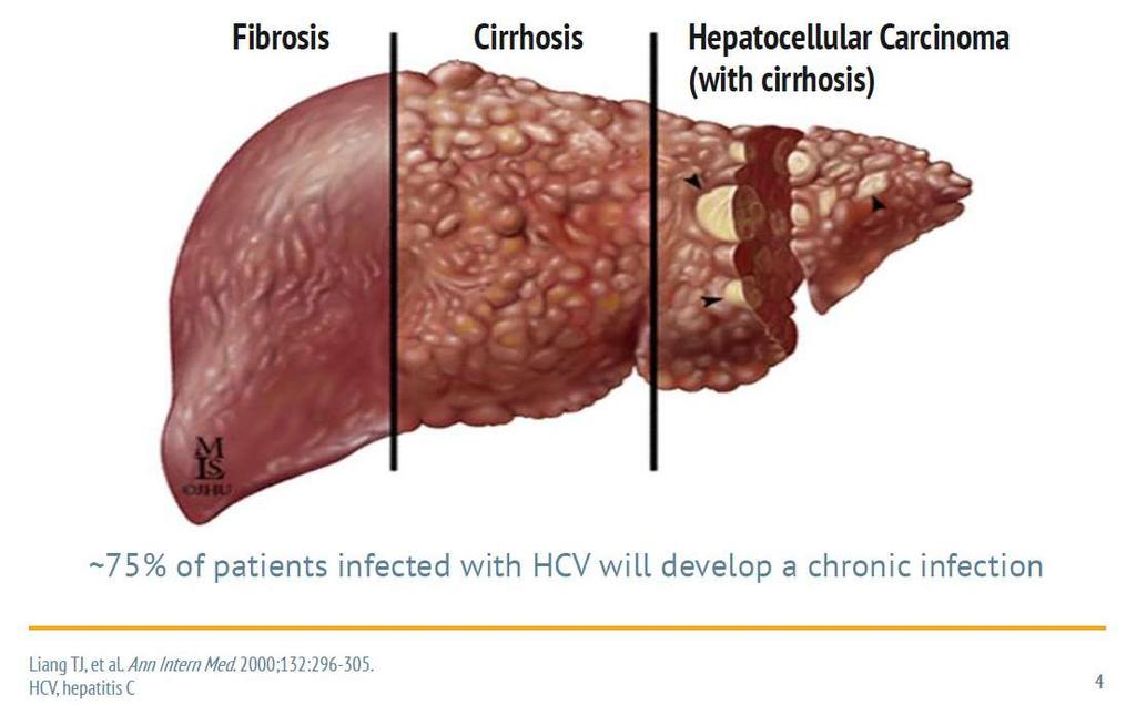 Chronic HCV infection may lead to liver disease and liver cancer Cirrhosis is the strongest risk factor for HCC, with hepatitis C virus (HCV) being a major