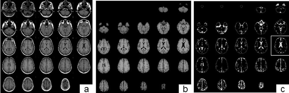 AJNR: 25, June/July 2004 WHOLE-BRAIN ATROPHY IN MULTIPLE SCLEROSIS 987 FIG 1. Semiautomated method of obtaining BPF. A, Raw T1-weighted 2D spin-echo noncontrast axial sequence.