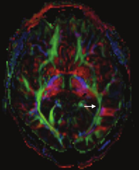 Case Reports in Neurological Medicine 3 Figure 2: Color coded fractional anisotropy (FA) maps obtained from the diffusion-tensor imaging (DTI) show collateral tissue