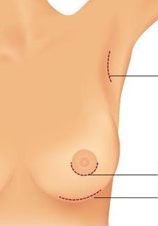 Breast Implant Incisions Minimising scarring is an art and a competition for cosmetic surgeons.