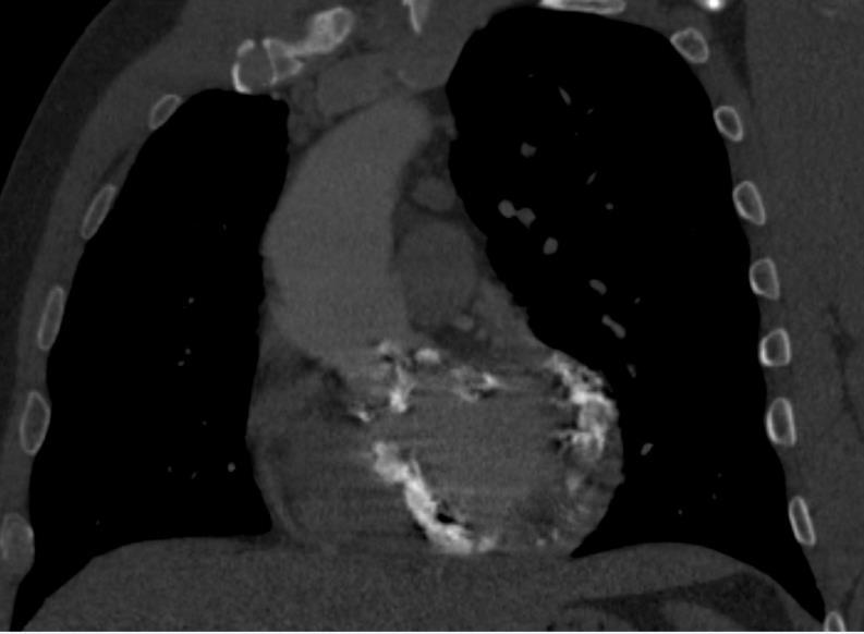 Case 2: 56 Year Old Male Symptomatic Severe Aortic Valve Stenosis Aneurysm of the ascending Aorta X-ray, CTScan: Extreme Calcification in the aortic root and