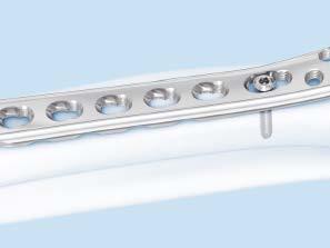 Be sure the plate is held securely to the bone to prevent plate rotation as the screw is locked to the plate.