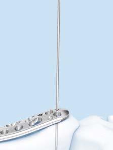 Reduction 2 Reduce articular surface Instruments 394.35 Large Distractor 532.010 Small Battery Drive 532.