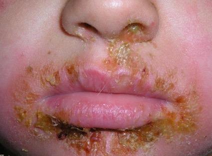 Superinfected Lip Lickers Dermatitis Staph bacteria spilling out