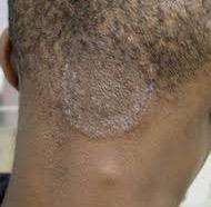 Kerion: Tinea Capitis Painful Swollen Crusted Mass Typical Tinea