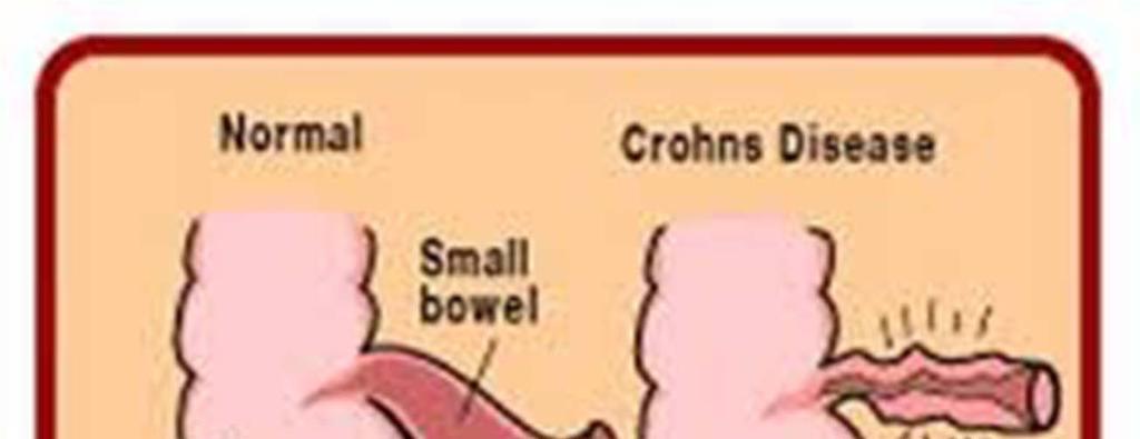Crohn s
