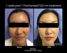 Case Report Below is a description of a case of a 46 year-old woman, who requested treatment for facial skin rejuvenation.