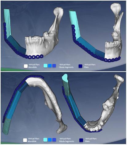 Virtual Surgical Planning in Craniomaxillofacial Reconstruction http://dx.doi.org/10.5772/59965 723 Figure 8.