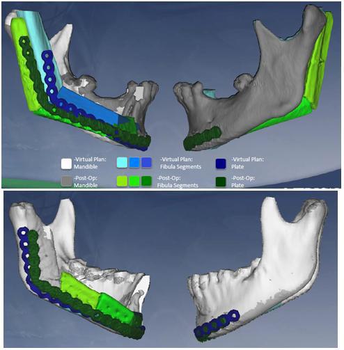 Virtual Surgical Planning in Craniomaxillofacial Reconstruction http://dx.doi.org/10.5772/59965 727 Figure 12.