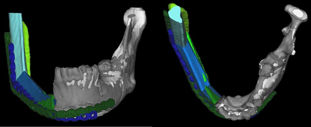 Virtual Surgical Planning in Craniomaxillofacial Reconstruction http://dx.doi.org/10.5772/59965 721 Figure 5. Intraoperatively, the fibular grafts are secured to the reconstruction plate. Figure 6.