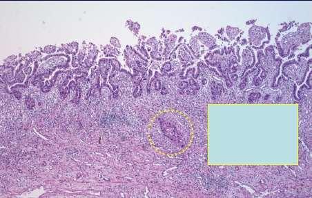 Intraepithelial