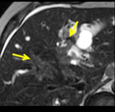 Bismuth-Corlette Type IV Tumor involves biliary