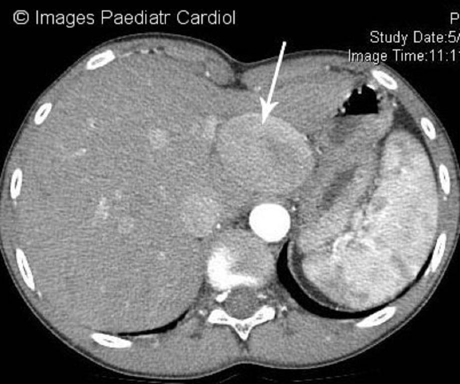 Figure 2: Abdominal CT axial image demonstrating the large heterogenous mass or