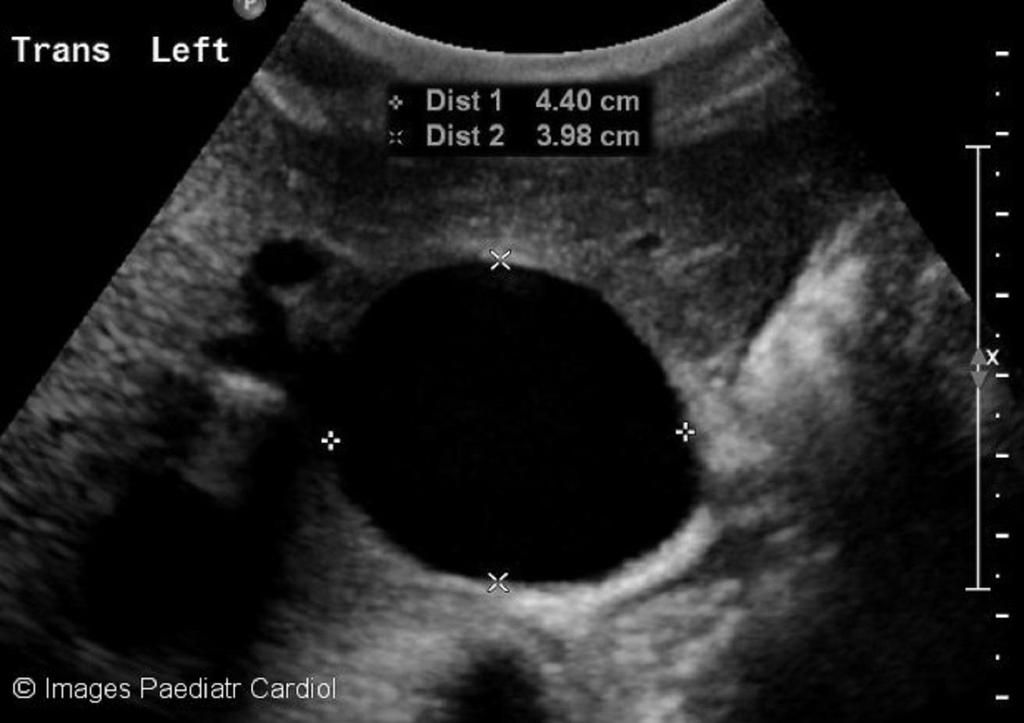 An abdominal ultrasound with Doppler performed after the CT scan was consistent with a patent aneurysm or pseudoaneurysm impressing upon the left hepatic lobe (Figure 5 and Figure 6).