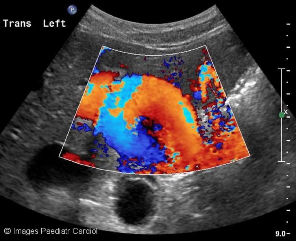 4 cm x 3.98 cm in this plane. Figure 6: Color Doppler demonstrating flow into the pseudoaneurysm.