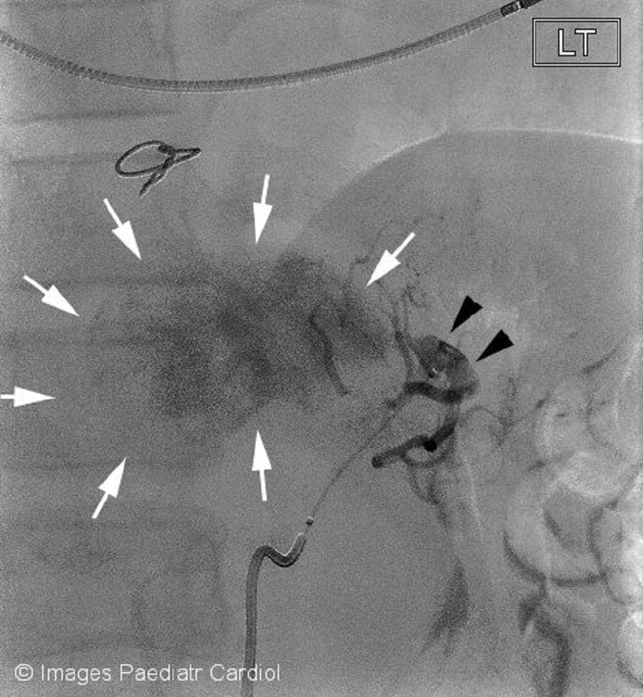Figure 7: Selective angiogram demonstrating flow into the left gastric artery and feeder vessel (black arrowheads) filling the large pseudoaneurysm (white arrows).