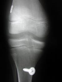 ACL Reconstruction in the Skeletally Immature: A Comparison of 2 Techniques Paletta